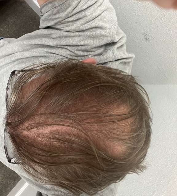 How Diet affects the Hair