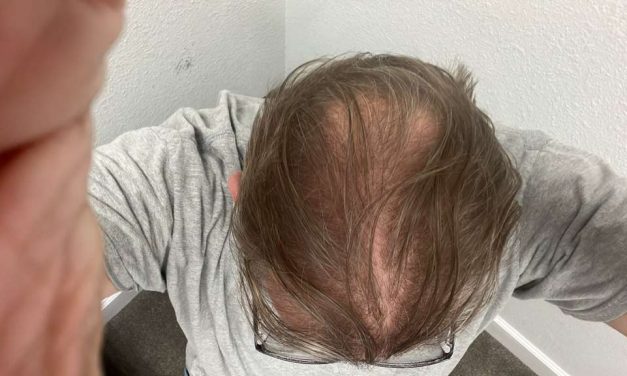 How Diet affects the Hair