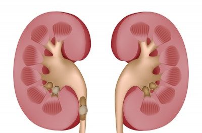 Kidney stones: who is at risk