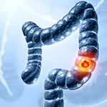 Truth about colon cancer