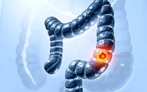 Truth about colon cancer