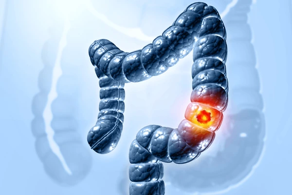 Truth about colon cancer