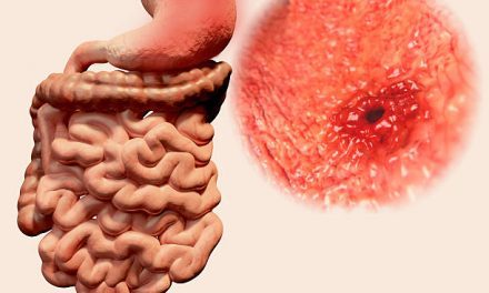 Tips to fix stomach ulcers