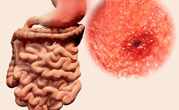 Tips to fix stomach ulcers