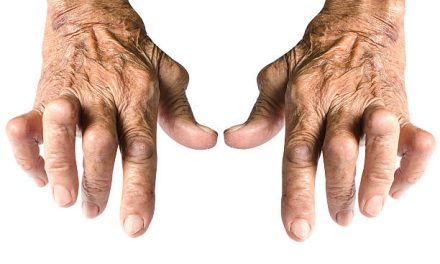 Living with Rhuematoid Arthritis (RA)