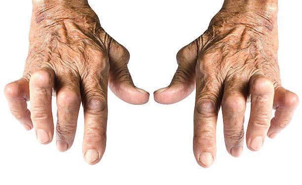 Living with Rhuematoid Arthritis (RA)