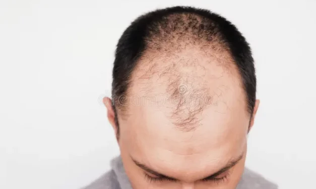 Tips on Preventing Baldness