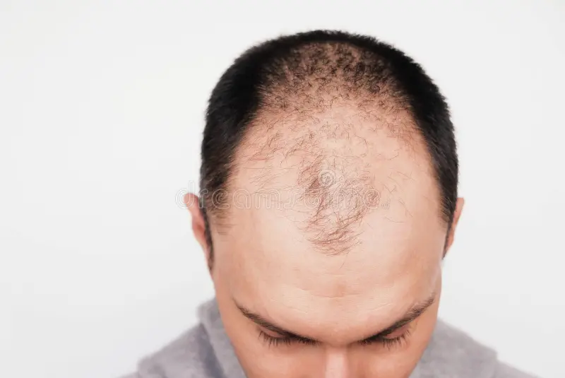 Tips on Preventing Baldness