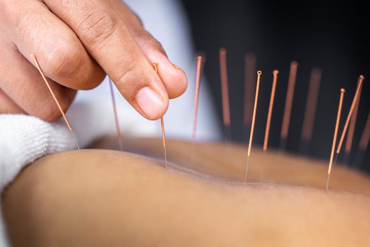 Get to the point with acupuncture