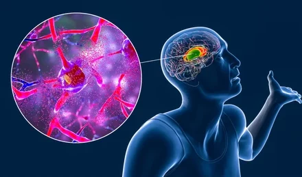 Huntington’s Disease