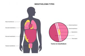 mesothelioma, malignant mesothelioma, pleural mesothelioma, peritoneal mesothelioma, asbestos exposure, occupational exposure, IARC carcinogen, latency period, biomarkers, mesothelin, BAP1 mutation, calretinin, WT1, diagnosis, CT scan, PET-CT, thoracoscopy, VATS biopsy, pathology, FIGO-like staging, TNM staging, talc pleurodesis, pleurectomy/decortication, extrapleural pneumonectomy, HIPEC, systemic therapy, pemetrexed, cisplatin, carboplatin, bevacizumab, immunotherapy, nivolumab, ipilimumab, radiation therapy, multimodality treatment, recurrence, prognosis, survival rates, SEER statistics, CDC data, NCI PDQ, NCCN guidelines, risk reduction, secondary exposure, legal/occupational health, surveillance, supportive care, pain management, palliative care, clinical trials, global burden