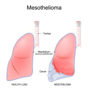 mesothelioma, malignant mesothelioma, pleural mesothelioma, peritoneal mesothelioma, asbestos exposure, occupational exposure, IARC carcinogen, latency period, biomarkers, mesothelin, BAP1 mutation, calretinin, WT1, diagnosis, CT scan, PET-CT, thoracoscopy, VATS biopsy, pathology, FIGO-like staging, TNM staging, talc pleurodesis, pleurectomy/decortication, extrapleural pneumonectomy, HIPEC, systemic therapy, pemetrexed, cisplatin, carboplatin, bevacizumab, immunotherapy, nivolumab, ipilimumab, radiation therapy, multimodality treatment, recurrence, prognosis, survival rates, SEER statistics, CDC data, NCI PDQ, NCCN guidelines, risk reduction, secondary exposure, legal/occupational health, surveillance, supportive care, pain management, palliative care, clinical trials, global burden