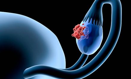 Ovarian Cancer