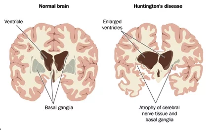 Huntington’s disease, HTT gene, CAG repeat expansion, autosomal dominant, anticipation, penetrance, juvenile HD, Westphal variant, chorea, dystonia, bradykinesia, motor symptoms, cognitive decline, executive dysfunction, psychiatric symptoms, depression, irritability, apathy, striatum, medium spiny neurons, caudate-putamen, neurodegeneration, MRI biomarkers, neurofilament light, CSF biomarkers, genetic testing, predictive testing, prenatal testing, preimplantation genetic testing, genetic counseling, Huntington-like disorders, HDL2, symptomatic treatment, tetrabenazine, deutetrabenazine, antipsychotics, SSRIs, multidisciplinary care, physical therapy, occupational therapy, speech therapy, palliative care, caregiver support, disease-modifying therapy, antisense oligonucleotides, RNAi, AMT-130, AAV gene therapy, CRISPR approaches, clinical trials, HDSA resources