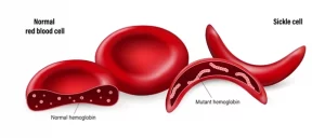 sickle cell disease, sickle cell anemia, hemoglobin S, HBB mutation, autosomal recessive, newborn screening, sickle cell trait, vaso-occlusive crisis, acute chest syndrome, splenic sequestration, aplastic crisis, hemolytic anemia, dactylitis, priapism, stroke prevention, transcranial Doppler, chronic transfusion, hydroxyurea, L-glutamine therapy, crizanlizumab, penicillin prophylaxis, vaccination schedule, folic acid, pain management, opioid stewardship, hydration, infection risk, parvovirus B19, pulmonary hypertension, renal complications, avascular necrosis, leg ulcers, retinopathy, pregnancy management, perioperative care, transfusion reactions, iron overload, chelation therapy, HSCT, bone marrow transplant, gene therapy, exa-cel, lovo-cel, psychosocial support, patient education, care coordination, transition to adult care, health disparities, quality of life, survivorship