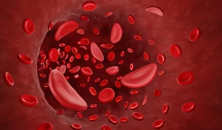 Sickle Cell Anemia