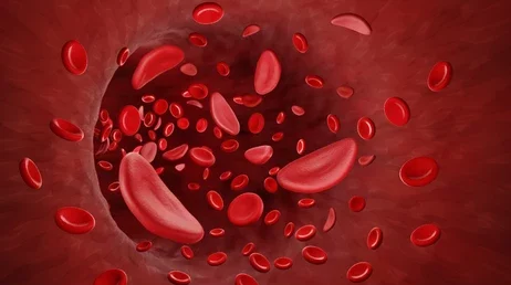 Sickle Cell Anemia