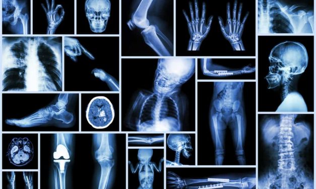 Treating osteogenesis imperfecta (OI) with Noni