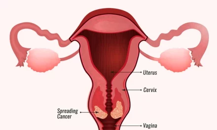 Cervical Cancer