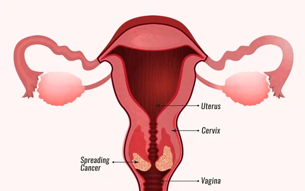 Cervical Cancer
