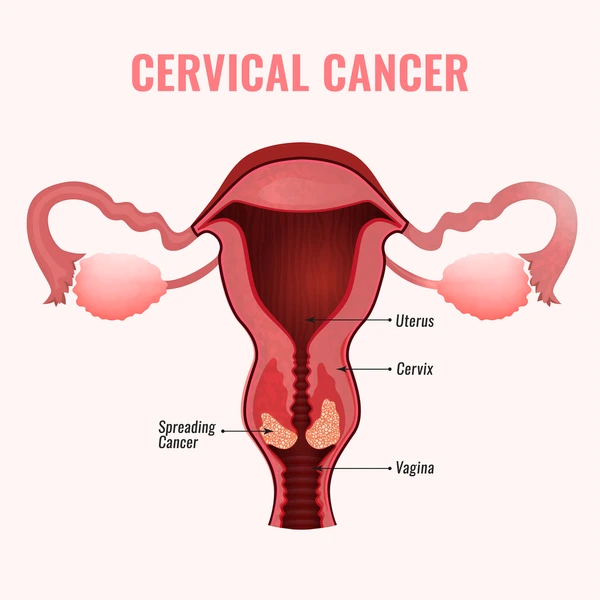 Cervical Cancer