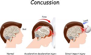 concussion, mild traumatic brain injury, mtbi, head injury, post-concussion syndrome, brain trauma, cognitive symptoms, memory loss, headaches, dizziness, nausea, light sensitivity, sound sensitivity, vision problems, balance issues, sleep disturbances, mood changes, irritability, depression, anxiety, concentration problems, slowed processing, fatigue, return to play, return to learn, second impact syndrome, chronic traumatic encephalopathy, cte, helmet safety, impact testing, baseline testing, neurocognitive testing, vestibular therapy, cervical strain, neck injury, rest and recovery, graded exercise, symptom tracking, red flags, loss of consciousness, vomiting, seizure after injury, emergency care, pediatric concussion, adolescent athletes, sports concussion, fall-related concussion, prevention tips, rehabilitation, neurologist consultation