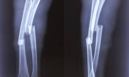 Osteomyelitis