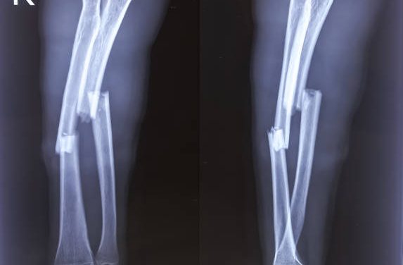 Osteomyelitis