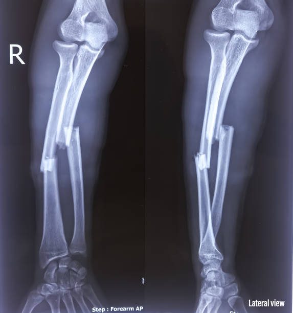 Osteomyelitis