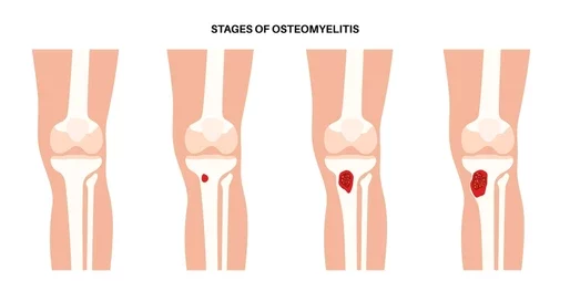 osteomyelitis, bone infection, acute osteomyelitis, chronic osteomyelitis, hematogenous spread, contiguous spread, vascular insufficiency, diabetic foot infection, Staphylococcus aureus, MRSA, Pseudomonas aeruginosa, Salmonella, biofilm, sequestrum, involucrum, Brodie abscess, periosteum, cortical bone, vertebral osteomyelitis, discitis, epidural abscess, fever, localized pain, swelling, erythema, sinus tract, probe-to-bone test, ESR, CRP, leukocytosis, blood cultures, MRI, bone scan, radiographs, bone biopsy, culture-directed antibiotics, intravenous antibiotics, surgical debridement, hardware removal, antibiotic beads, rifampin combinations, suppression therapy, revascularization, amputation risk, pediatrics, neonates, sickle cell disease, tuberculosis osteomyelitis, fungal osteomyelitis, limb salvage