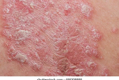 Psoriasis autoimmune disorder issues