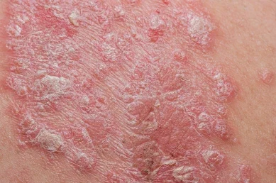 Psoriasis autoimmune disorder issues