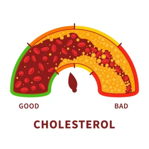 tag words: cholesterol, LDL cholesterol, HDL cholesterol, triglycerides, atherosclerosis, plaque, heart attack, stroke, peripheral artery disease, vascular dementia, angina, endothelial dysfunction, inflammation, statins, PCSK9 inhibitors, ezetimibe, lipids, dyslipidemia, metabolic syndrome, insulin resistance, type 2 diabetes, hypertension, obesity, diet, saturated fat, trans fat, fiber, exercise, smoking cessation, risk factors, screening, lipid panel, total cholesterol, non-HDL cholesterol, apolipoprotein B, lifestyle change, Mediterranean diet, omega-3, cardiovascular disease, ASCVD, primary prevention, secondary prevention, carotid disease, coronary arteries, arterial stiffness, blood clots, thrombosis, plaque rupture, PAD symptoms, erectile dysfunction, brain health
