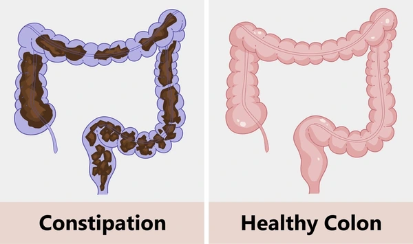 Cleansing Your Colon Naturally