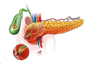 pancreatitis, acute pancreatitis, chronic pancreatitis, revised Atlanta classification, interstitial edematous, necrotizing pancreatitis, BISAP score, Ranson criteria, SIRS, organ failure, gallstone pancreatitis, alcohol-related, hypertriglyceridemia, hypercalcemia, drug-induced, post-ERCP, autoimmune pancreatitis, genetic pancreatitis, PRSS1, SPINK1, CFTR, abdominal pain, elevated lipase, amylase, CT pancreas, MRCP, endoscopic ultrasound, ERCP, cholangitis, fluid resuscitation, lactated Ringer’s, early enteral feeding, antibiotics not prophylactic, pain control, cholecystectomy, pancreatic necrosis, walled-off necrosis, step-up approach, minimally invasive necrosectomy, pancreatic pseudocyst, exocrine insufficiency, fecal elastase, PERT (enzyme therapy), diabetes risk, smoking cessation, alcohol abstinence, nutrition support, multidisciplinary care, recurrence prevention, follow-up imaging