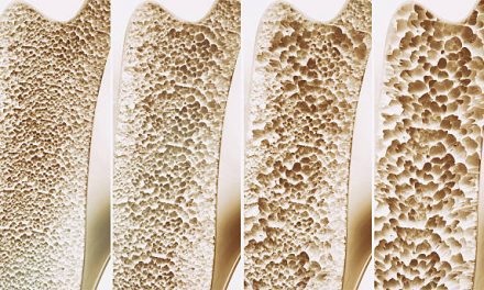 Staying Ahead Of Osteoporosis
