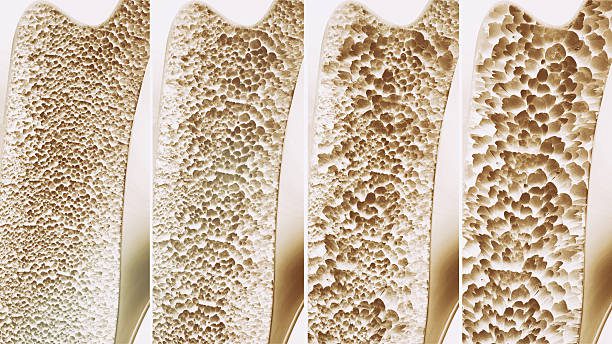 Staying Ahead Of Osteoporosis