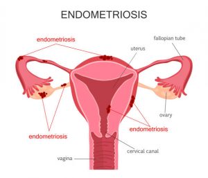 endometriosis, chronic pelvic pain, dysmenorrhea, dyspareunia, infertility, subfertility, abnormal bleeding, endometrioma, chocolate cyst, deep infiltrating endometriosis, adenomyosis, peritoneal lesions, ovarian endometriosis, bowel involvement, bladder involvement, neuropathic pain, central sensitization, pelvic floor dysfunction, rASRM staging, Endometriosis Fertility Index, ultrasound, MRI, laparoscopy, histologic confirmation, CA-125 (limited utility), differential diagnosis, IBS overlap, interstitial cystitis, migraines, autoimmune associations, NSAIDs, combined oral contraceptives, progestins, levonorgestrel IUD, dienogest, GnRH agonists, GnRH antagonists, add-back therapy, aromatase inhibitors, laparoscopic excision, ablation, cystectomy, adhesion prevention, multidisciplinary care, pelvic floor physical therapy, cognitive behavioral therapy, nutrition support, fertility preservation, IVF, adolescent endometriosis, pregnancy considerations, long-term follow-up