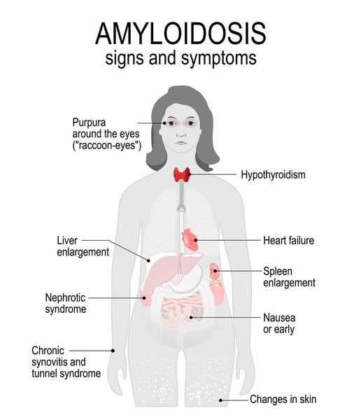 about Amyloidosis