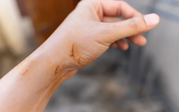 about Cat Scratch Fever disease