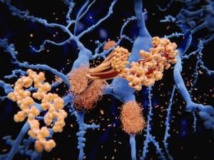 amyloidosis, AL amyloidosis, light-chain amyloidosis, AA amyloidosis, ATTR amyloidosis, ATTRwt, ATTRv, transthyretin, TTR gene, Congo red, apple-green birefringence, tissue biopsy, fat pad aspirate, amyloid typing, mass spectrometry, SAP scintigraphy, PYP scintigraphy, cardiac amyloidosis, restrictive cardiomyopathy, heart failure with preserved EF, arrhythmias, neuropathy, autonomic dysfunction, carpal tunnel syndrome, macroglossia, periorbital purpura, nephrotic syndrome, proteinuria, renal insufficiency, hepatomegaly, gastrointestinal dysmotility, spinal stenosis, tenosynovial biopsy, free light chains, serum/urine immunofixation, bone marrow biopsy, tafamidis, patisiran, inotersen, vutrisiran, acoramidis, daratumumab, bortezomib, cyclophosphamide, dexamethasone, stem cell transplant, supportive care, diuretics, multidisciplinary care, early diagnosis
