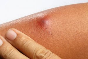 cat scratch disease, cat scratch fever, Bartonella henselae, kitten exposure, flea vectors, Ctenocephalides felis, inoculation papule, pustule, regional lymphadenitis, axillary nodes, cervical nodes, fever, malaise, fatigue, hepatosplenic involvement, hepatic lesions, splenic lesions, neuroretinitis, Parinaud oculoglandular syndrome, encephalopathy, bacillary angiomatosis, peliosis hepatis, culture-negative endocarditis, ocular bartonellosis, conjunctivitis, erythema nodosum, arthralgia, myalgia, rash, suppuration, lymph node aspiration, ultrasound lymph node, serology, IFA titers, PCR testing, Warthin–Starry stain, differential diagnosis, toxoplasmosis, tularemia, atypical mycobacteria, prevention, flea control, scratch wound care, avoid rough play, immunocompromised hosts, HIV, pediatrics, self-limited infection, azithromycin, doxycycline, gentamicin (endocarditis)