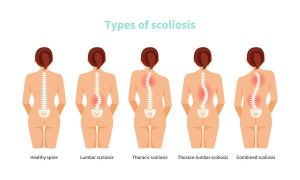 scoliosis, adolescent idiopathic scoliosis, idiopathic scoliosis, congenital scoliosis, neuromuscular scoliosis, degenerative scoliosis, early-onset scoliosis, infantile scoliosis, juvenile scoliosis, thoracic curve, lumbar curve, thoracolumbar curve, double major curve, coronal imbalance, sagittal imbalance, kyphoscoliosis, Cobb angle, Risser sign, curve progression, screening, Adams forward bend test, scoliometer, radiographs, vertebral rotation, rib hump, back pain, postural asymmetry, leg-length discrepancy, bracing, Boston brace, TLSO, Charleston bending brace, Providence brace, physiotherapy scoliosis-specific exercises, Schroth method, observation, skeletal maturity, menarche timing, curve monitoring, MRI indications, pulmonary function, restrictive lung disease, vertebral body tethering, posterior spinal fusion, pedicle screws, complications, quality of life, return to sport, genetics, family history