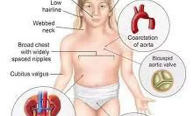 about Turner Syndrome