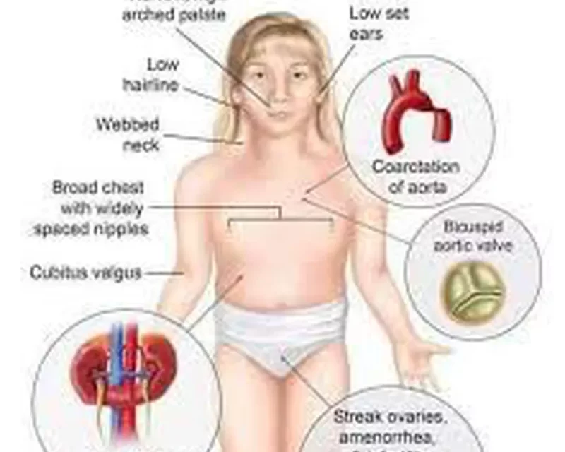 about Turner Syndrome