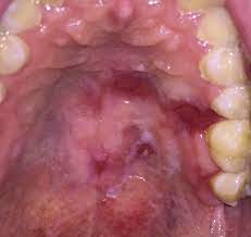 Fanconi Anemia