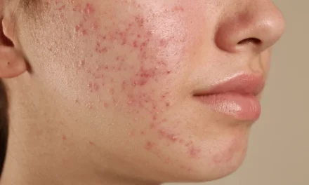 Teen Acne Problems?
