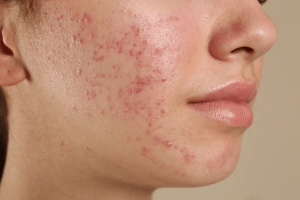 Acne Prevention Tips for Teens