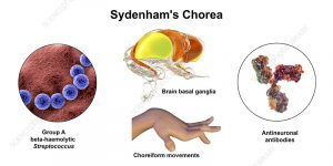 Sydenham's chorea is a movement disorder. It is the most common type of acquired chorea. Meaning your child isn't born with it, it is "a