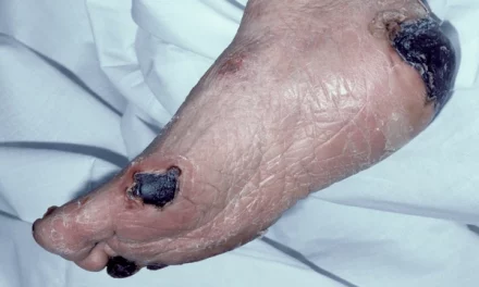 about Gangrene